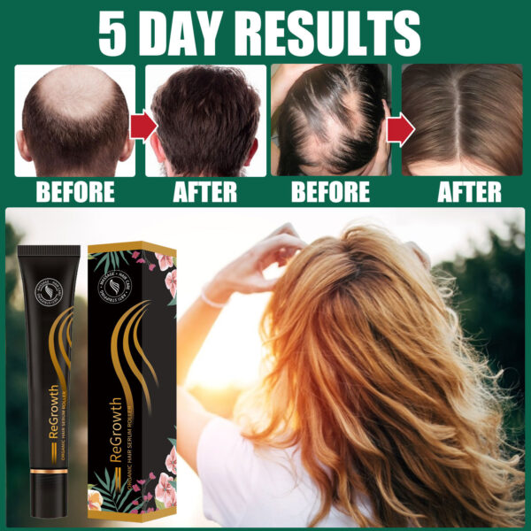 Regrowth Organic Hair Serum Roller Set Hair Care Anti Stripping Liquid Suitable For All Types Of Hair Loss Scalp Nourishing - Image 6